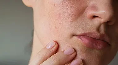 بهترین روش تشخیص و روتین مراقبت پوست های مختلط+روش های ساده ارزان